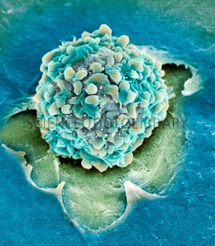 M1320936-Rectal_cancer_cell,_SEM-SPL.jpg